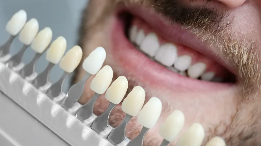 O que não pode comer com lente de contato dental O que não pode comer com lente de contato dental